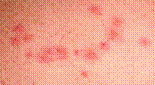 Photo of Bed Bug Bites in threes (sometimes referred to as Breakfast ...