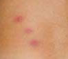 Bed Bugs Bites - Photos-Pictures | Charleston,Myrtle Beach ...